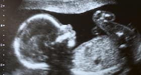 What is fetal distress?
