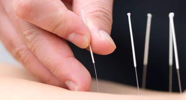 acupuncture