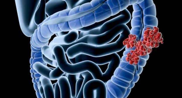 colon-cancer