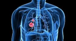 लंग कैंसर रहता है सुषुप्त अवस्था  में