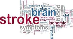 New neuroendovascular technique promises hope for stroke patients with large-vessel clots