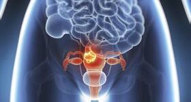 5 risk factors for endometrial cancer that every woman should know