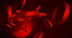 Are you suffering from lupus? Follow these natural remedies