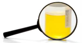 11 causes of dark coloured urine you might not know about
