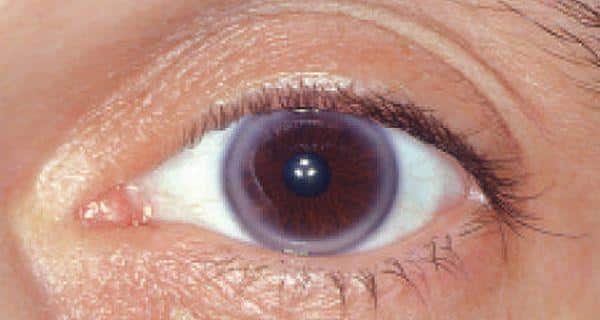 Understanding Limbal Rings and Why They Are Attractive - TTDEYE