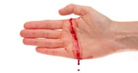 Researchers have developed a new cost-effective method to diagnose rare bleeding disorder