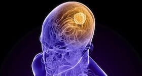 20% of patients diagnosed with brain tumour every year are children: Study