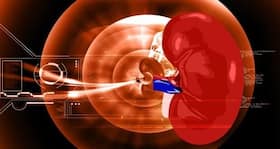 New drug therapy to help kidney transplantation