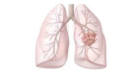 Mystery behind the spreading of lung cancer revealed