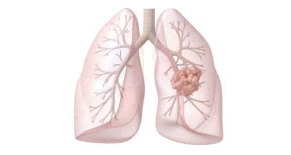 Stereotactic body radiation therapy (SBRT) for lung cancer increases one's risk of non-cancer death