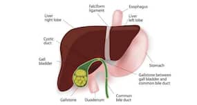 Herbal remedies for gallstones