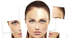 Get rid of blemishes from face and back with these home remedies