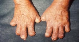 What India needs to do to get rid of leprosy