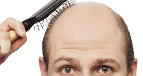 Men Balding Or A Good Sex Life The Choice Is Yours