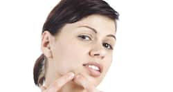 It's time you stopped popping your pimples!