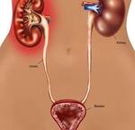 Pyelonephritis