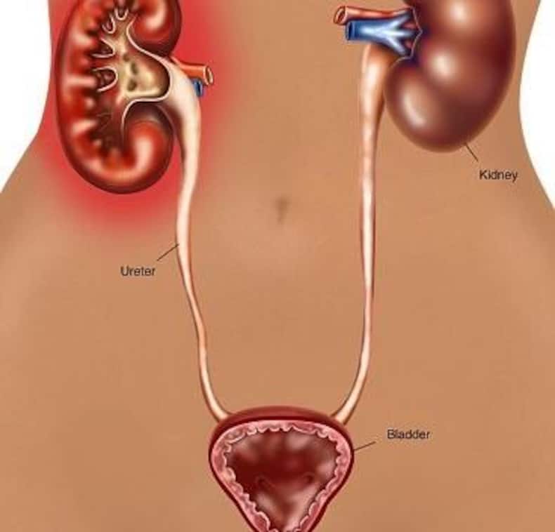 pyelonephritis