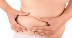 6 common causes of stretch marks