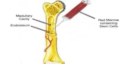 World Marrow Donor Day: Bone Marrow Transplant Is The Only Curative Treatment For Most Fatal Blood Disorders