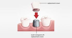 Dental crowns -- All you need to know Dental crowns -- All you need to know
