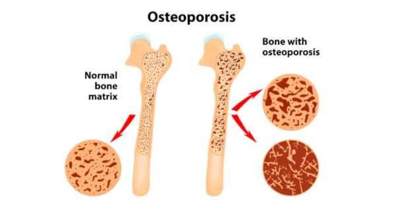 Osteoporosis