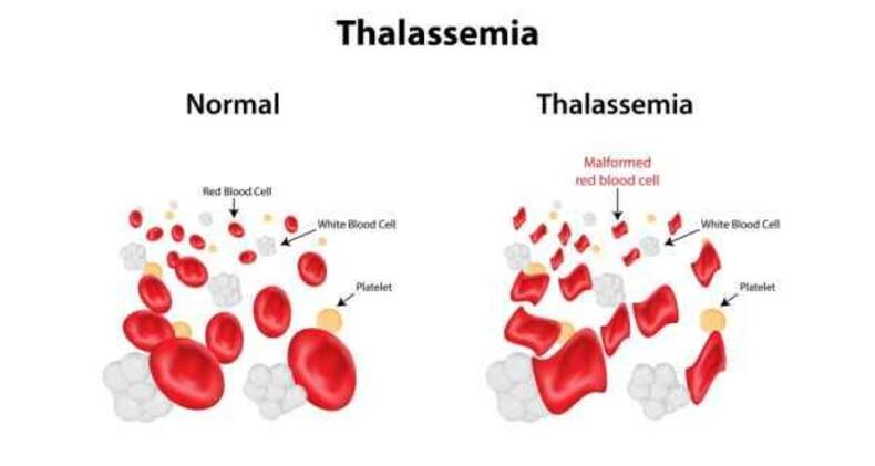 Thalassemia
