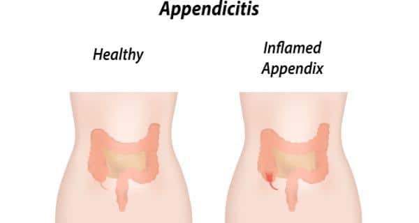 appendix pain in children