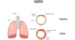 COPD