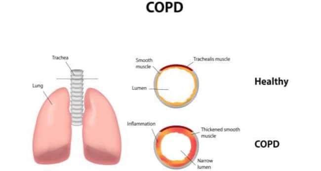copd
