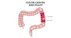 Colorectal Cancer