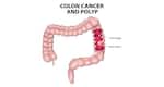 Colorectal Cancer