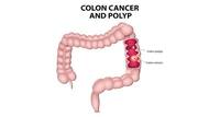 Colorectal Cancer