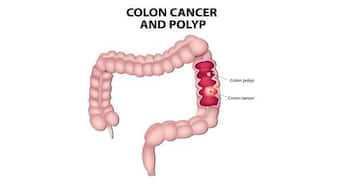 Colorectal Cancer