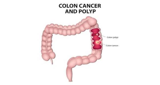 colorectal-cancer