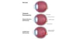 Diabetic retinopathy