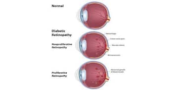 Diabetic retinopathy