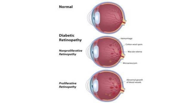 diabetic-retinopathy