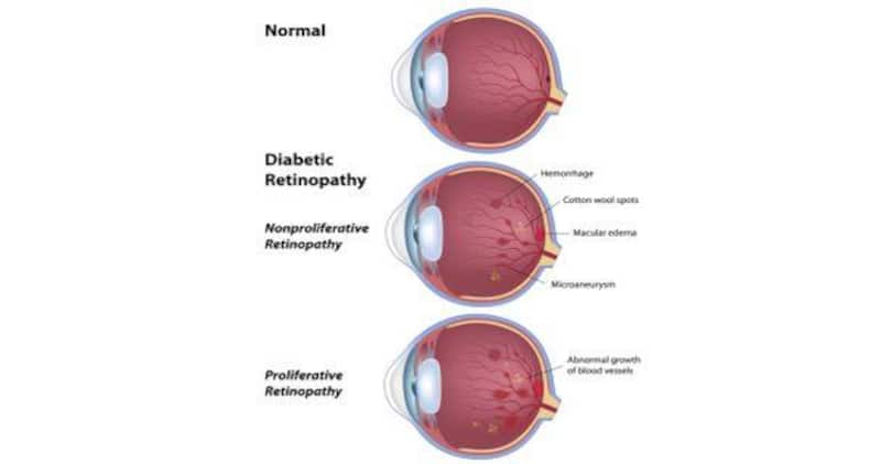 diabetic-retinopathy
