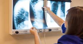 शहरों में रहने वाले 60 फीसदी लोग हैं Brittle bone disease से परेशान