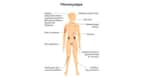 Fibromyalgia
