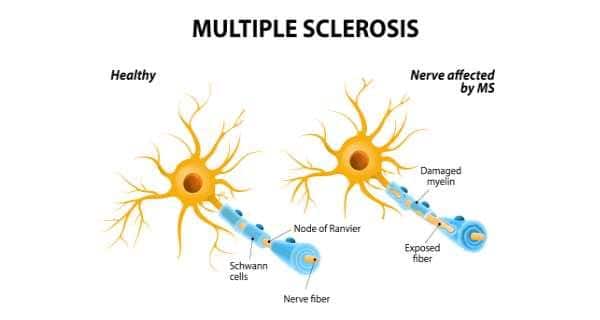 Multiple sclerosis - Health Tips, Multiple sclerosis Health Articles ...