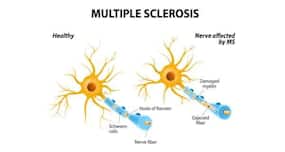 Did you know that deficiency of good bacteria in your gut could lead to multiple sclerosis?