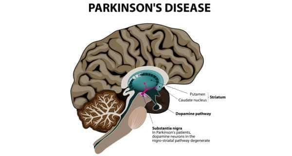 Parkinson's disease