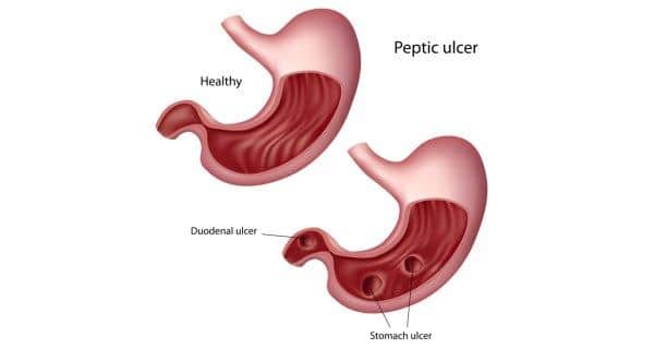 Peptic Ulcer Health Tips Peptic Ulcer Health Articles Health News Thehealthsite Com