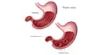 Peptic ulcer