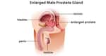 Prostate enlargement