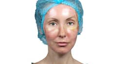 Rosacea: Causes, types, symptoms and treatment options