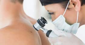 All about skin tags
