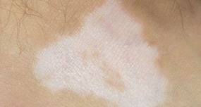 Vitiligo patients' skin color restored with arthritis medicine