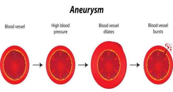 Aneurysm Symptoms Aneurysm Causes And Surgery Aneurysm Treatment And Risk Aneurysm Test